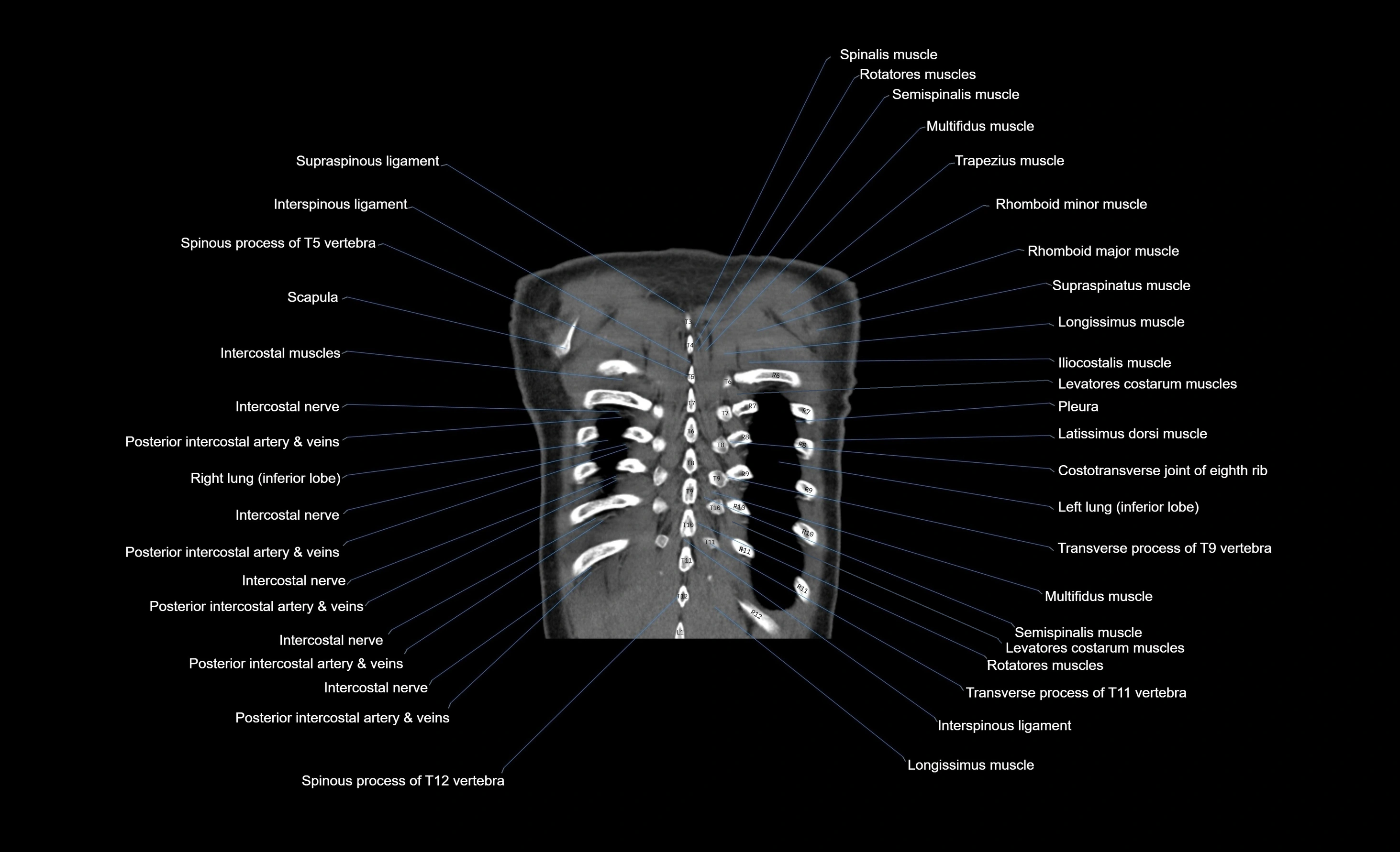 CT chest (thorax) labelled coronal cross sectional anatomy radiology image-00015.webp